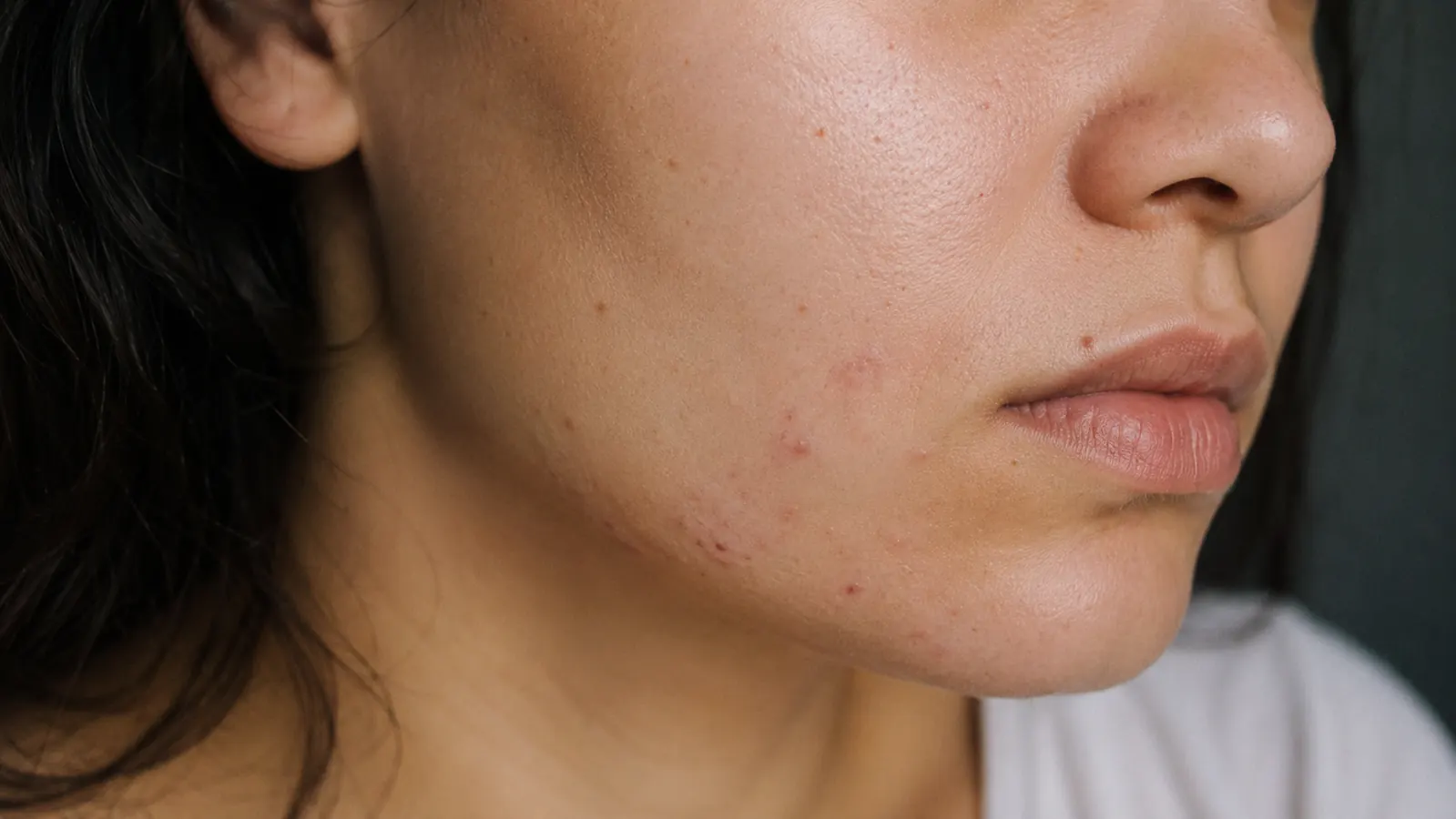 Close-up of a small breakout cluster along the jawline, meant to illustrate a temporary adjustment period